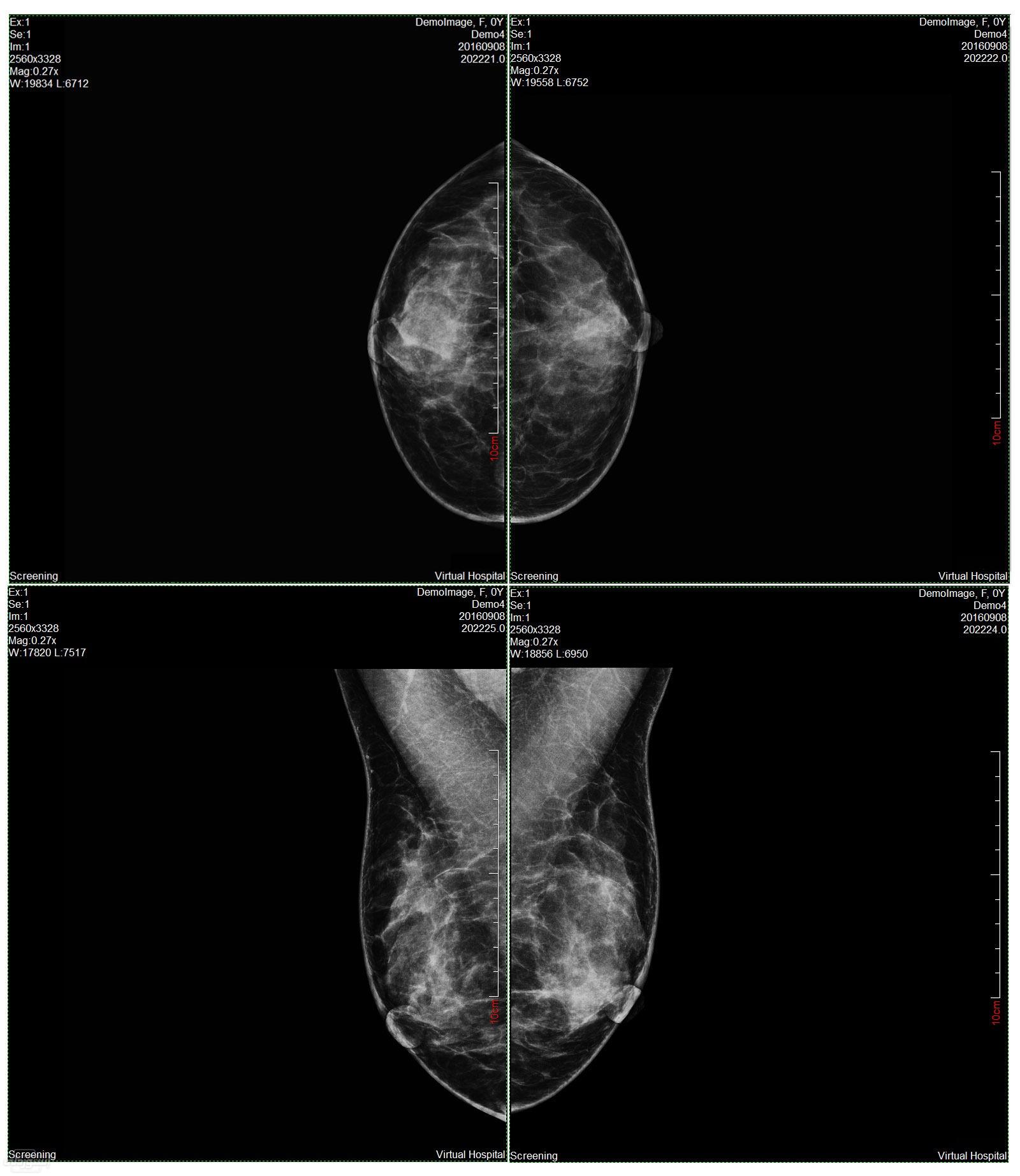digital-mammography-x-ray-breast-diagnos_main-5