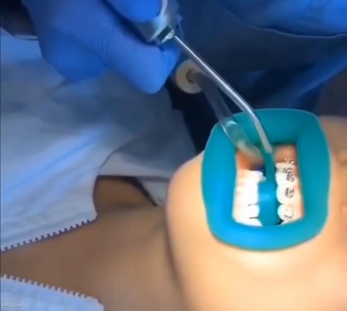 mouth-opening-device-oral-care-silicone_main-5 (1)